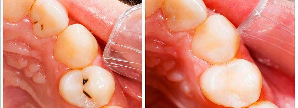 Kunststofffüllung  Zahnarztpraxis Dr. Carsten Schneider